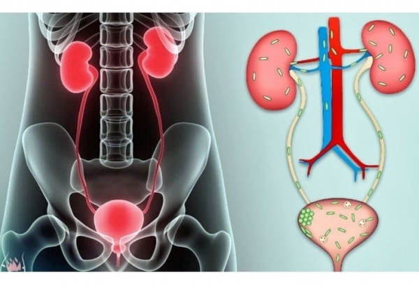 Новые данные могут помочь ускорить лечение ИМП у детей