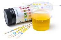 Новый биомаркер в моче помогает в диагностике бокового амиотрофического склероза