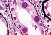 Биомаркеры BK-вирусной инфекции могут быть выявлены в анализах мочи