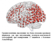 Белок болезни Альцгеймера может распространяться как инфекция