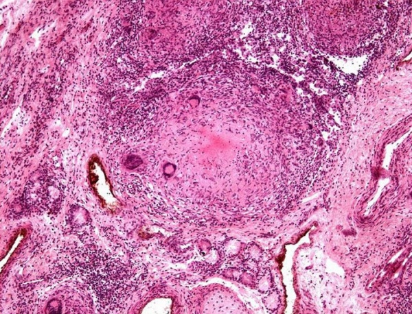 Новый взгляд на воспаление почек у пациентов с СКВ, вызванное УФ