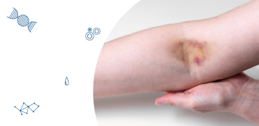 Как избежать гематомы после венепункции?