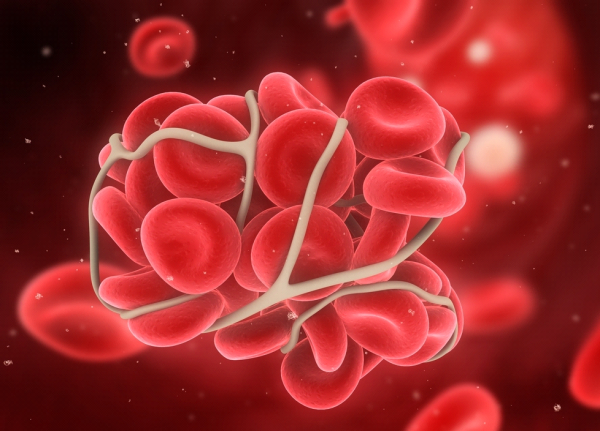 D-dimer у пациентов с COVID-19  и подозрением на венозную тромбоэмболию